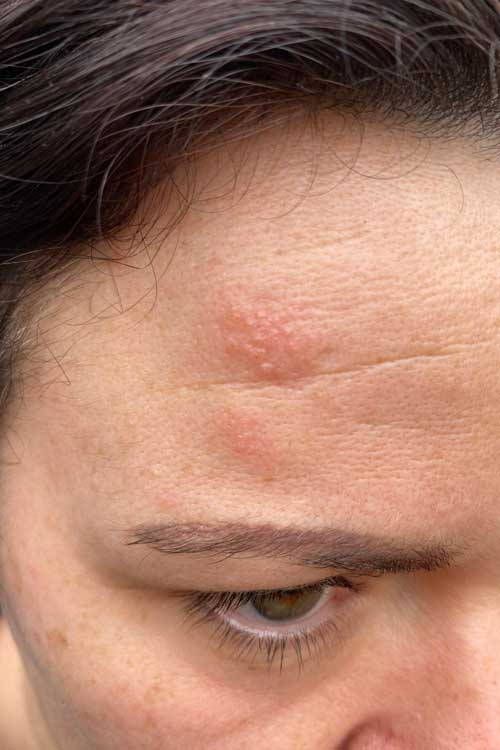 images Pictures Of Shingles On Your Face covid 19 stress north shore mums