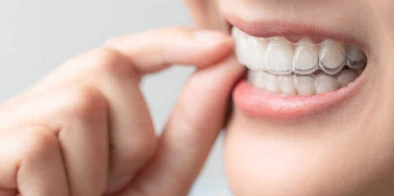 Straighten your teeth from home with Byte clear aligners | Australia