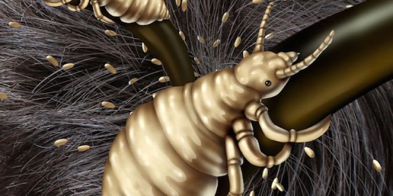 A closer look at head lice and nits! | North Shore Mums A closer look at head lice and nits! | North Shore Mums